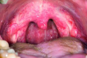 sore throat acute pharyngitis spl 17 927x617 1